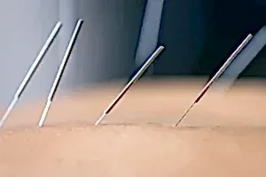 Altın İğne Uygulaması