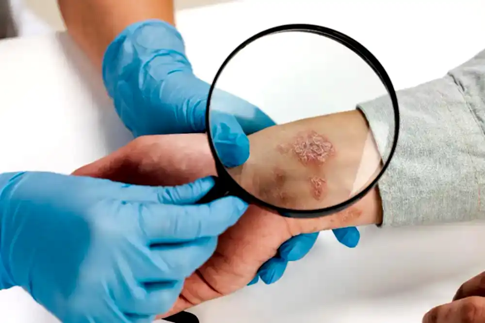 Genital Siğil Ankara HPV Tedavisi