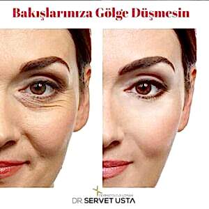 Göz Çevresi Botoksu Ankara
