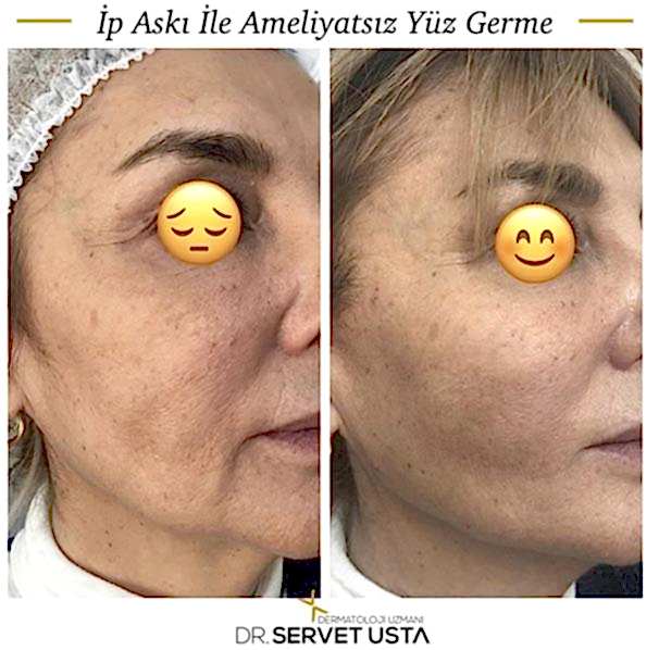 Ameliyatsız Estetik