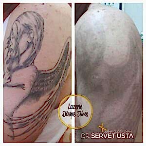 Lazer ile Dövme Silme Uygulaması