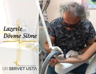 Lazer ile Dövme Silme