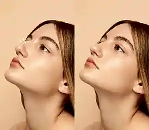 Burun Dolgusu Etkisi ne kadar kalır